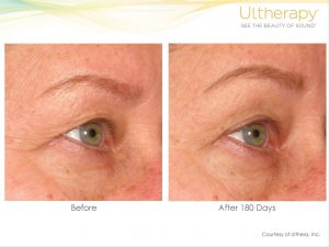 Ultherapy Gallery