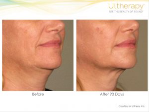 Ultherapy Gallery